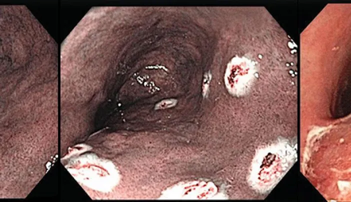 Preservación de órganos frente a cirugía inmediata para el adenocarcinoma de esófago